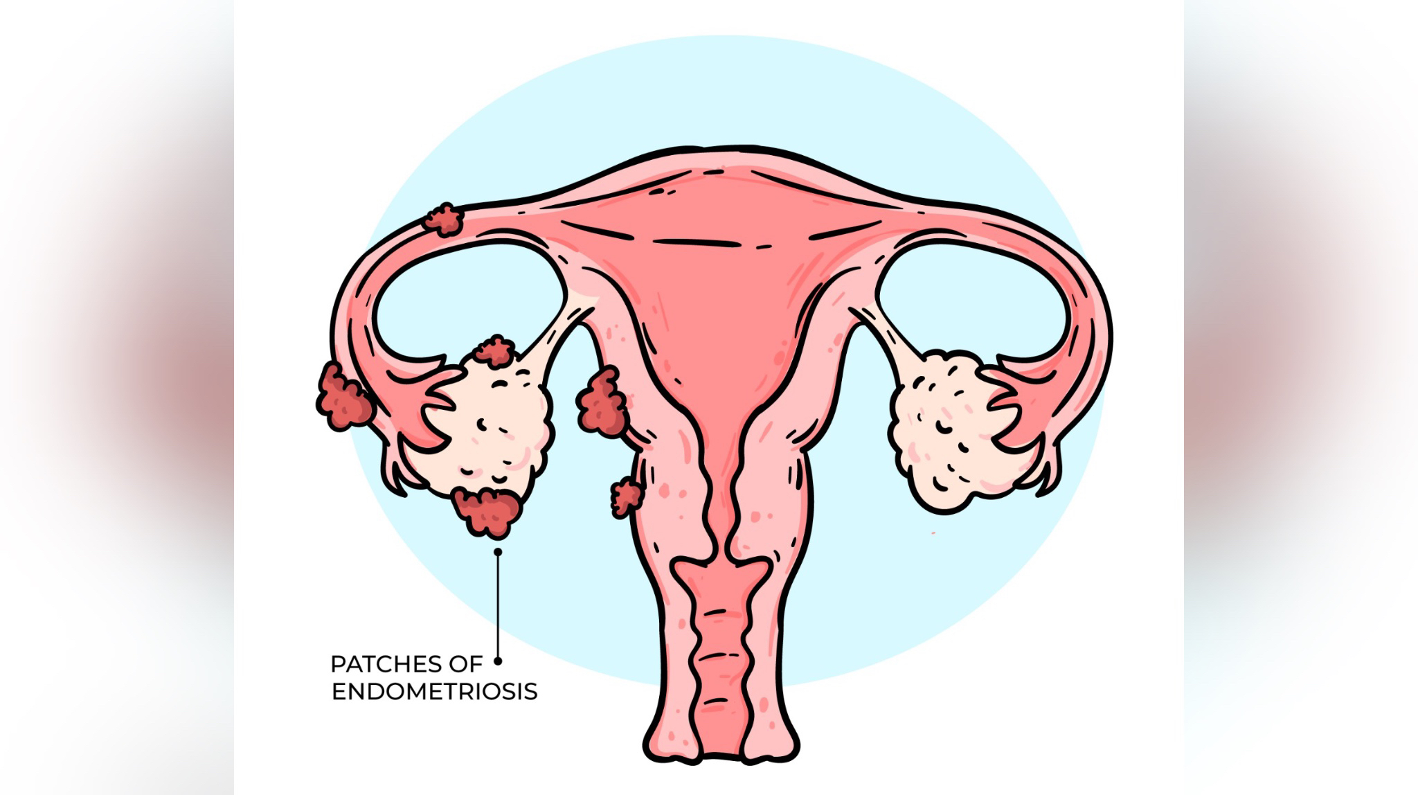 ENDOMETRIOSIS/CRÉDITO: FREEPIK